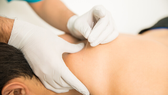 Dry needling